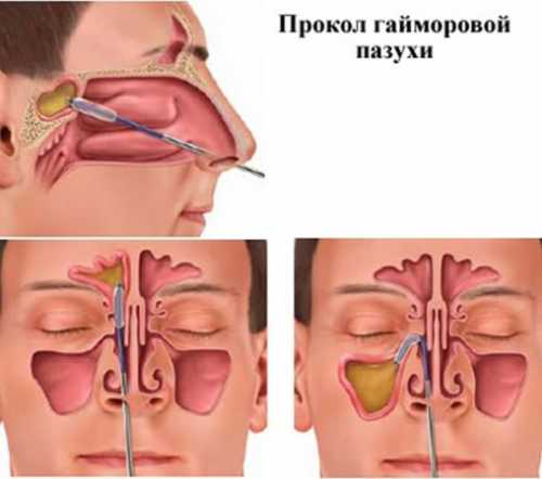 горечь в горле: причины, лечение